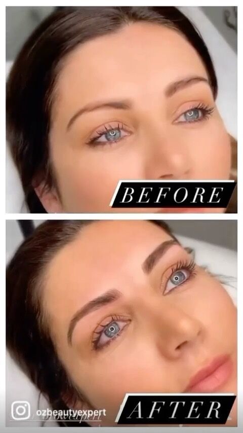 Step by step process of Nano Brows for the beautiful @ozbeautyexpert by Zar

#sydney #sydneysalon #pottspoint #beauty #feathertouch #featherstroke #featherbrows #micropigmentation #semipermanentmakeup #permanentmakeup #hudabeauty #browgame #browenvy #browtattoo #browsonpoint #browsonfleek #bbloggers #sydneyblogger #archaddicts #bondi #bondibeach #tattoo #anastasiabrows #hdbrows #brows #instagood not #microblading